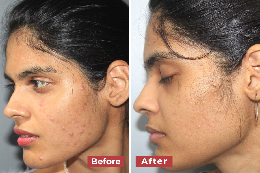 Side-by-side comparison showing a young woman’s left profile before and after acne treatment. The “before” image shows visible acne lesions and redness, while the “after” image displays clearer, smoother skin.