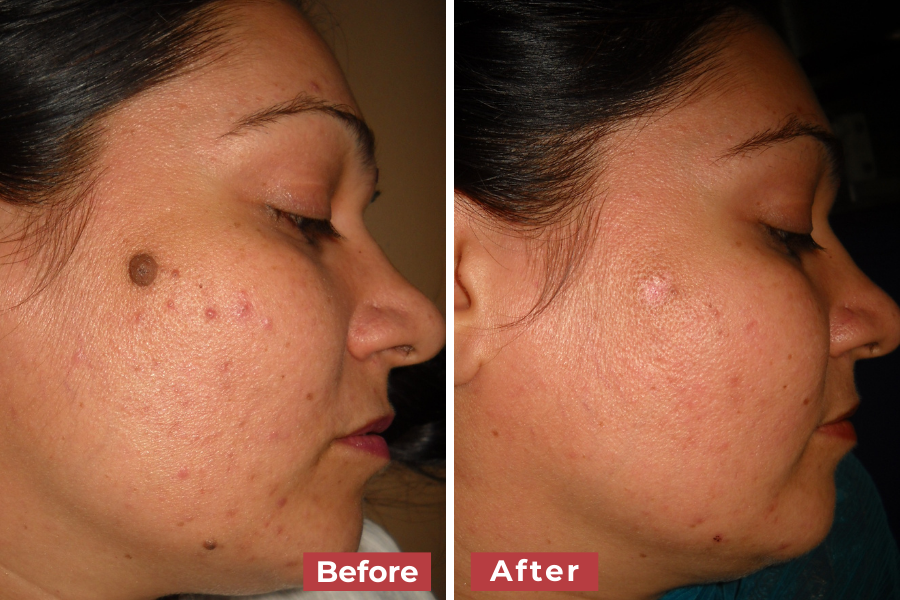 Side-by-side comparison of a woman's left profile showing improvement in acne and skin texture. The “before” image displays acne spots and a noticeable mole, while the “after” image shows reduced acne and smoother skin.