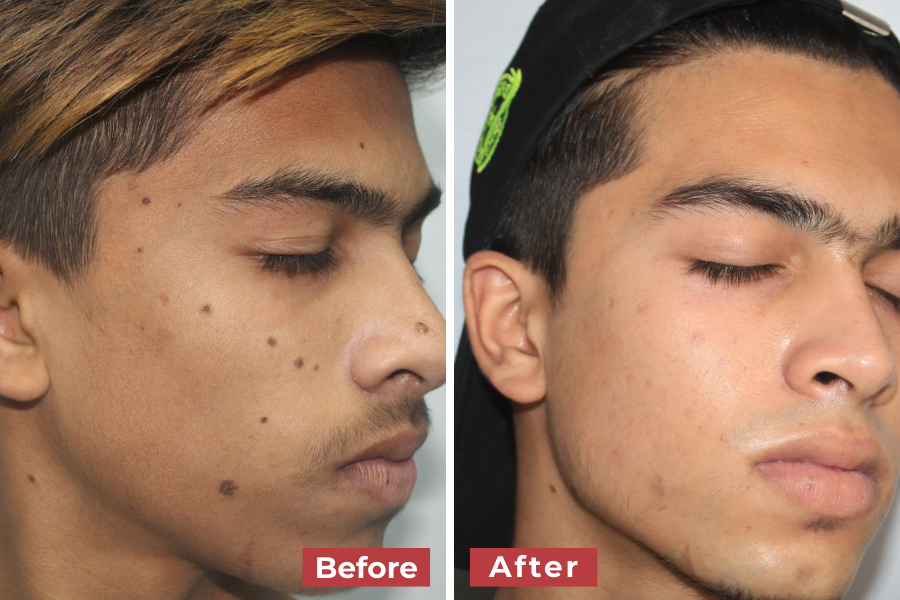 Side-by-side profile images of a young man’s face showing improvement in multiple dark moles and skin clarity. The “before” image shows several dark moles and blemishes, while the “after” image reveals clearer skin with significantly reduced moles and blemishes.