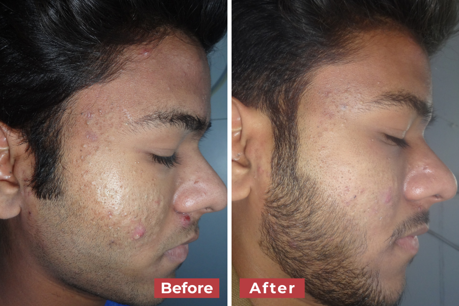 Side-by-side profile photos of a young man's face showing visible reduction in acne and skin inflammation. The "Before" image shows several inflamed acne spots on the cheek and near the nose. The "After" image shows significantly clearer skin with reduced redness and inflammation.