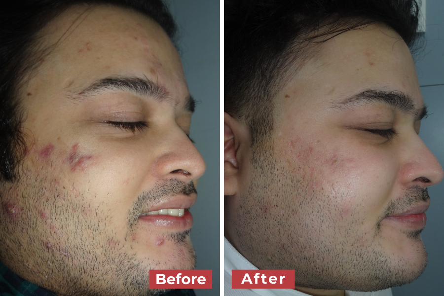 Side-by-side profile photos of a young man’s face showing noticeable improvement in acne. The “Before” image shows inflamed red acne spots on the cheek and jawline, while the “After” image shows significantly clearer skin with reduced redness and fewer acne marks.
