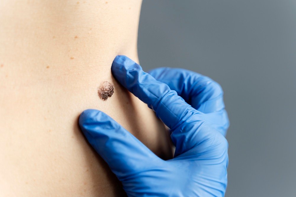 A gloved medical professional examines a large dark mole or skin lesion on a patient’s torso.