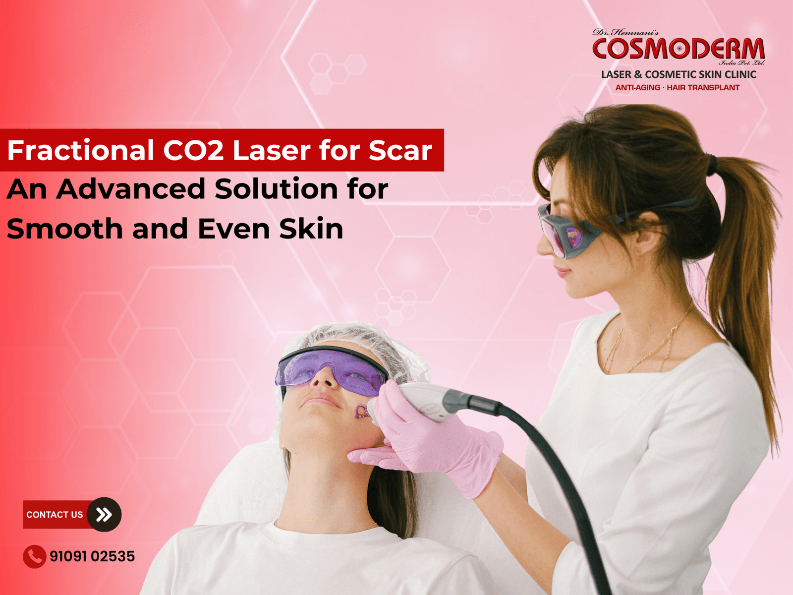 Advanced Fractional CO2 laser treatment used to reduce acne scars and improve skin texture at Cosmoderm Laser & Cosmetic Skin Clinic, Indore.