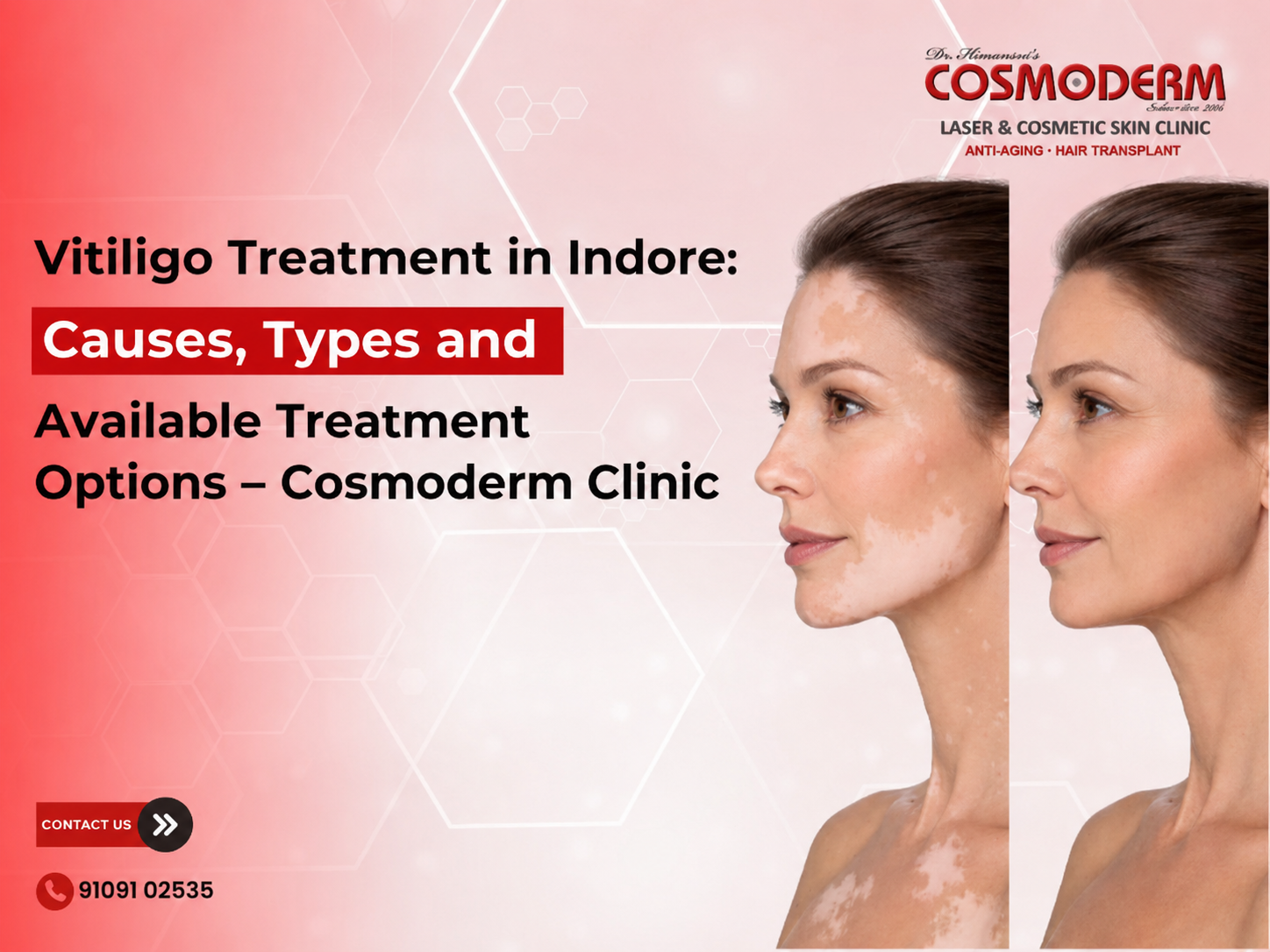 Vitiligo Treatment in Indore infographic featuring causes, types, and available treatment options, with a before-and-after illustration of facial vitiligo.