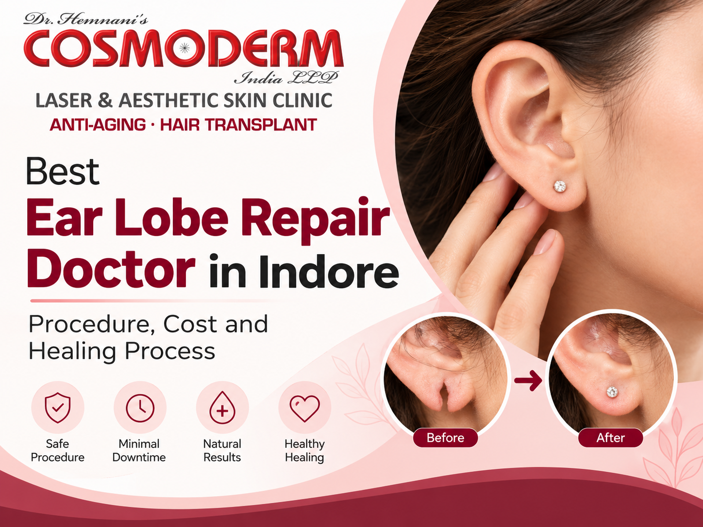 Best Ear Lobe Repair Doctor in Indore – Procedure, Cost and Healing Process
